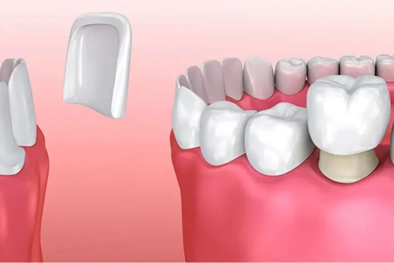 Quelle est la différence entre facette dentaire et couronne dentaire
