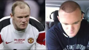 Wayne Rooney greffe cheveux avant apres