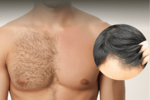 greffe cheveux avec poils torse