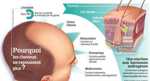 maladies auto-immunes et perte de cheveux