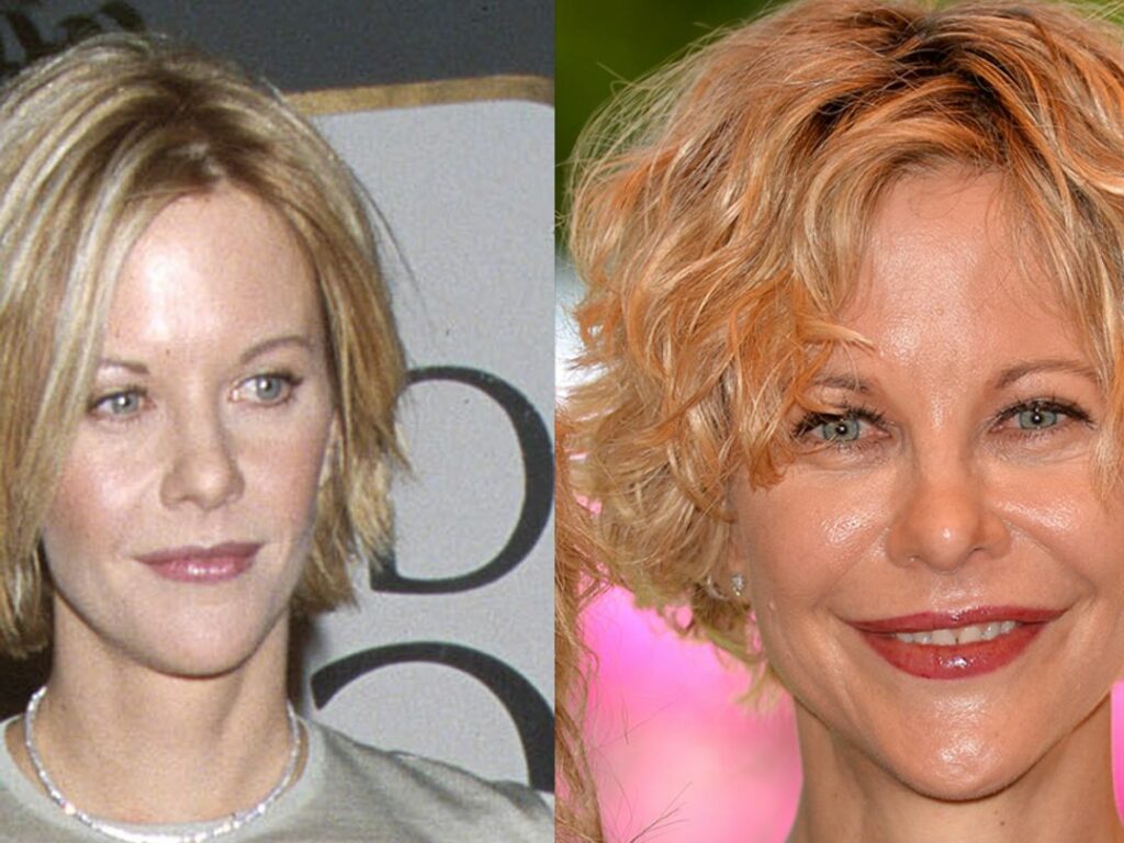 Meg Ryan chirurgie esthétique