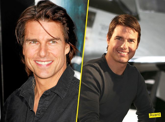 Tom Cruise chirurgie esthétique